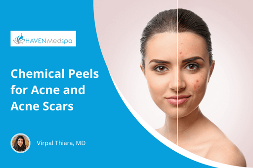 chemical-peel-for-acne