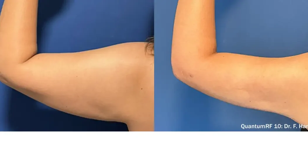 What happens during a QuantumRF treatment