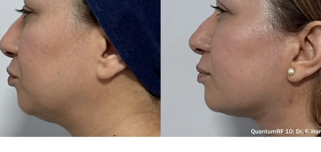 how does quantumrf tighten skin and reduce fat
